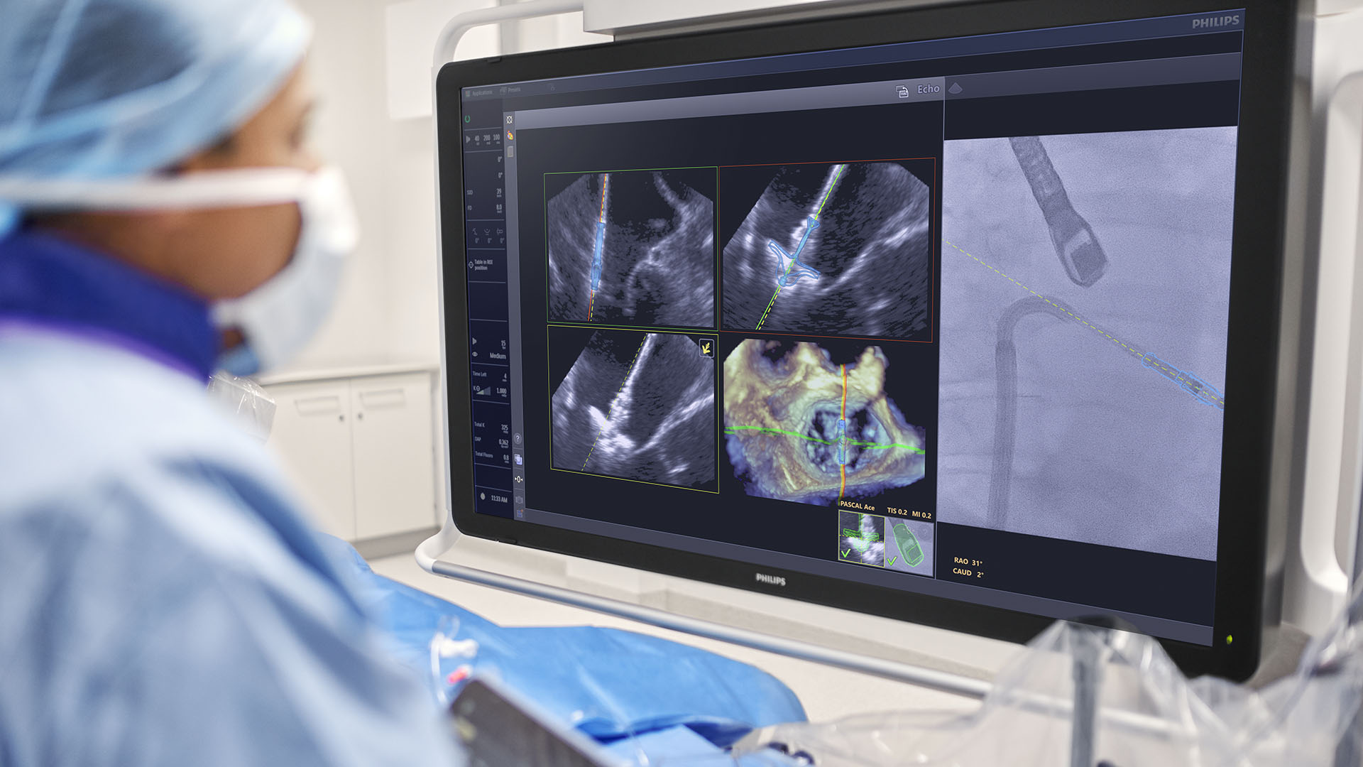 FDA clears Philips AI solution that provides real-time guidance during complex minimally invasive heart valve repair